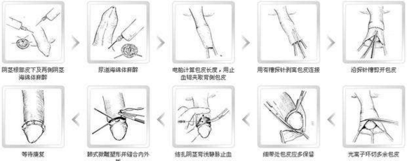 最新包皮手术方法，现代医疗科技的革新之旅